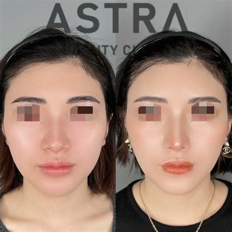 鼻尖形成・軟骨移植・隆鼻術・脂肪注入額・顎下脂肪吸引 【公式】astra Beauty Clinic（アストラビューティクリニック）｜美容