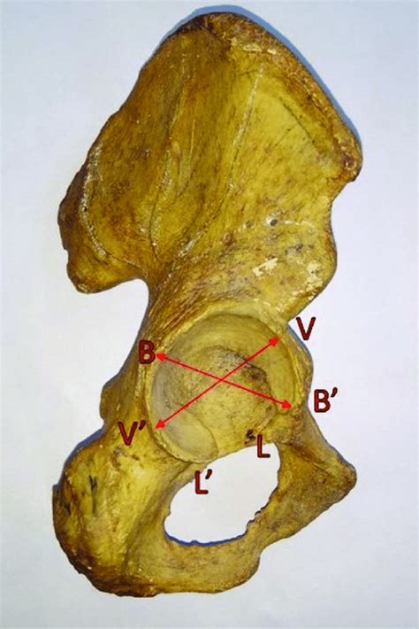 Right Sided Hip Bone Showing Landmarks For Various Acetabular Parameters Download Scientific