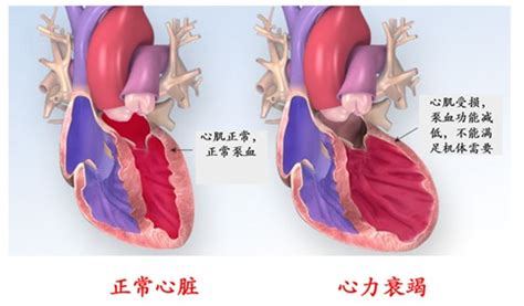 心力衰竭受伤的发动机 京东健康