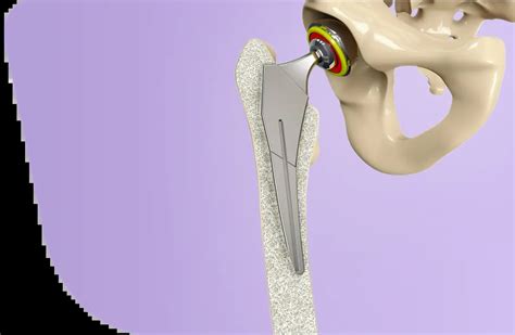 Hip Arthroplasty