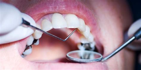 Let’s Understand the Tooth Cavity Treatment! - eLiveStory