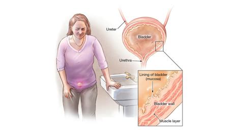 Interstitial Cystitis Drugs Market Size Share Growth Forecast By 2031