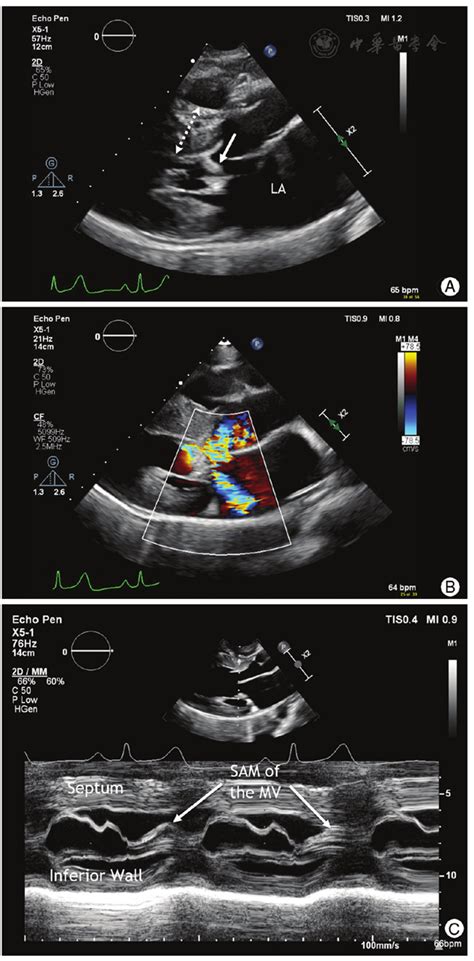 The Pregnancy Heart Team Approach For The Adult With Hypertrophic