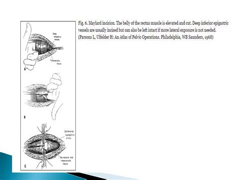 Abdominal Incisions Ppt