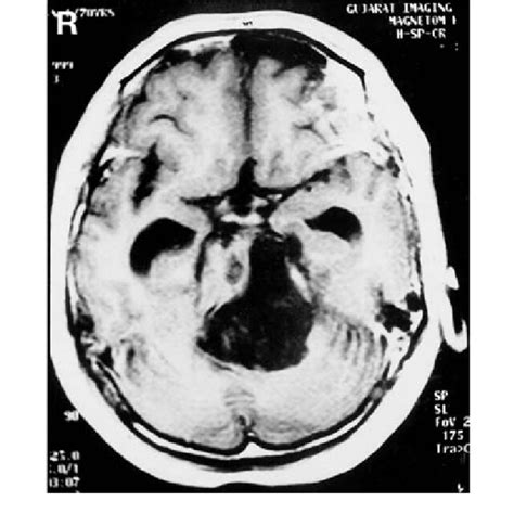 Preoperative Axial T Weighted Magnetic Resonance Image Showing The