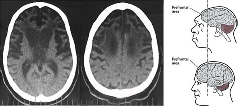Als Brain
