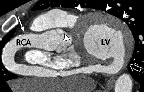 Coronary Artery Fistulas Pathophysiology Imaging Findings And