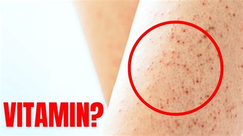 1 Vitamin To Cure Keratosis Pilaris Chicken Skin Youtube