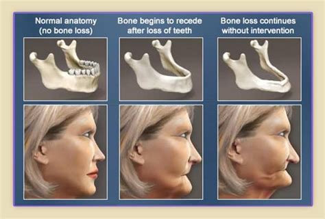 What Causes Bone Loss In Your Jaw Dental Implants Cost Dental Life