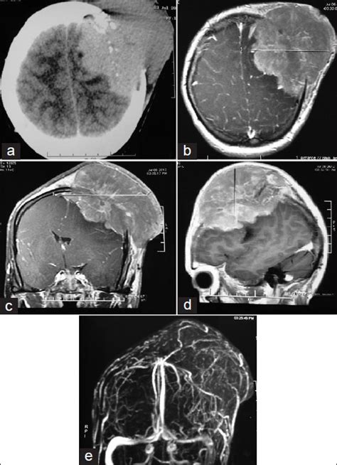 A Case Of Multiple Myeloma Presenting As Scalp Swelling With