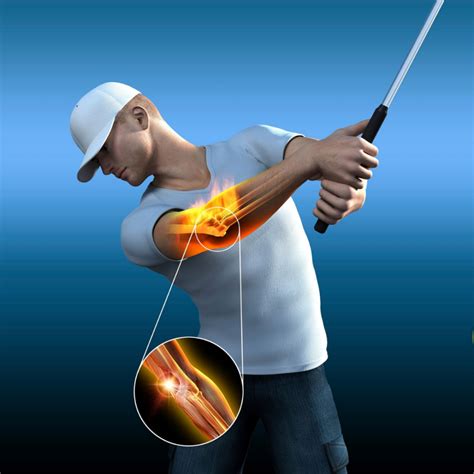 Recognizing Golfers Elbow Nysmi Dr Neil Roth Md