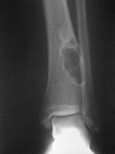 Fibroma Osificante Femur