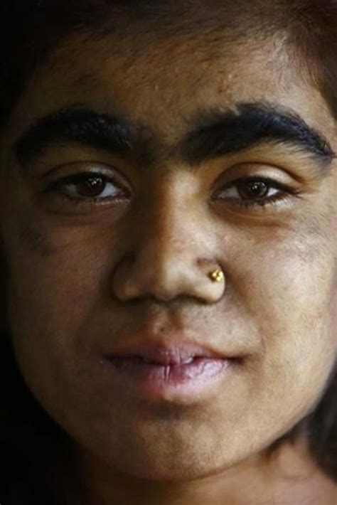 Post News: Living With “Werewolf Syndrome” (28 Pics)