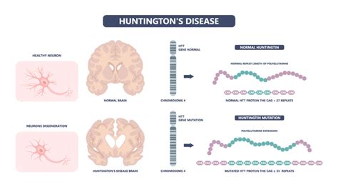 Phase Iii Trial Of Aso Therapy For The Treatment Of Huntingtons