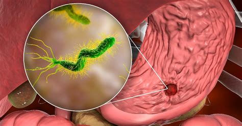 Ésta es la bacteria que podría estar en tus alimentos y aumenta el