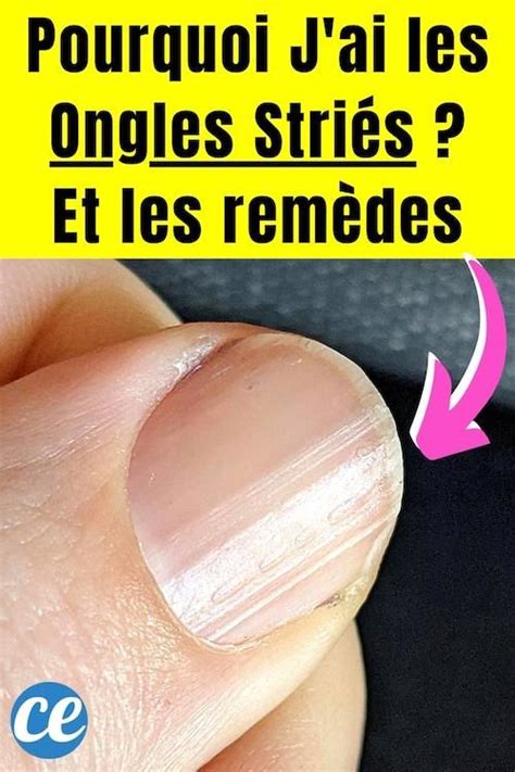 Vous Avez Les Ongles Stri S Moi Aussi Mes Ongles Ont Des Lignes