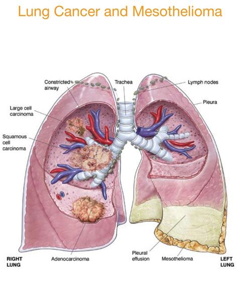 Asbestos Jar !: Mesothelioma, Asbestos Lung Cancer, Asbestosis And ...