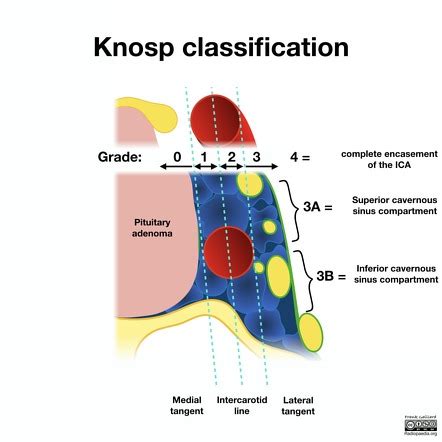 Knosp Classification Diagrams Radiology Case Radiopaedia Org