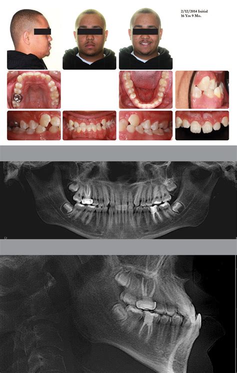 Class Iii Treatment In 15 Months By Alan A Curtis Dds Ms Orthotown