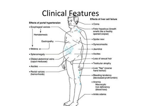 Ppt Liver Cirrhosis And Its Complications Powerpoint Presentation