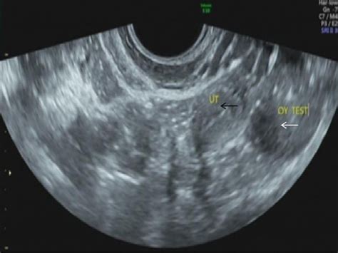 Transrectal Ultrasound Gynecological Examination Indicates That The Download Scientific Diagram