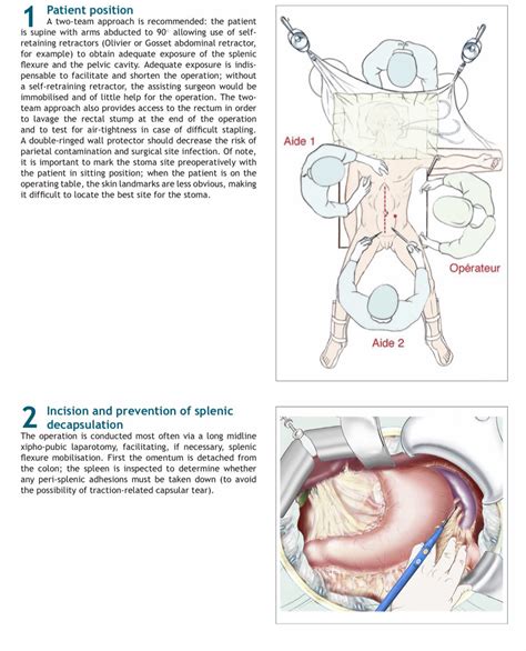 Cirbosque SoMe4Surgery On Twitter Saturday Must Know Procedure