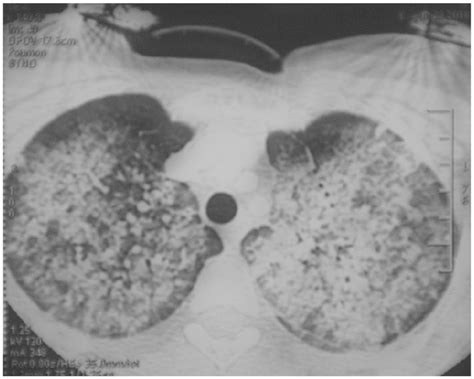 Thoracic Ct Scan Shows Diffuse Pulmonary Edema Download Scientific