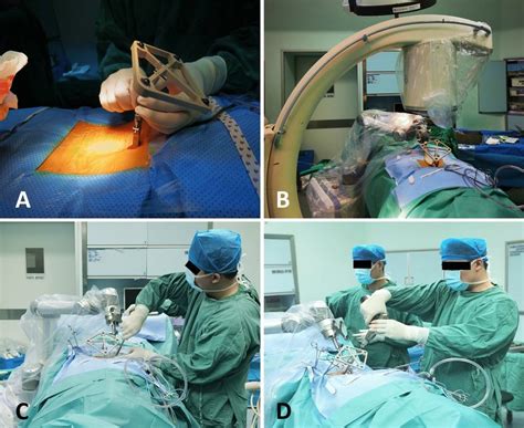 Procedures Of The Tirobot System A Installing The Spinous Process