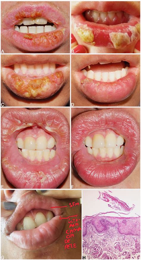 Cheilitis Exfoliativa