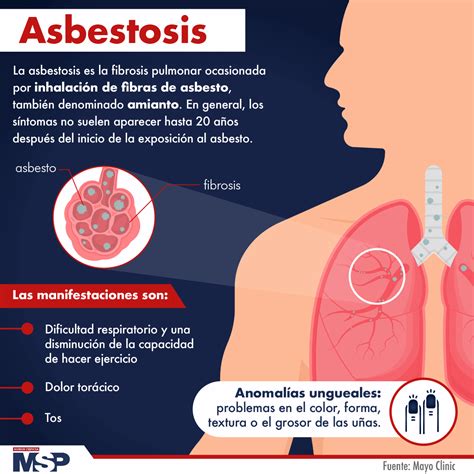 Asbestosis Una Enfermedad Oculta Histoimagen