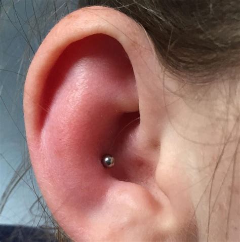 Infected Ear Cartilage Piercing