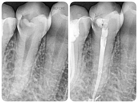 Root Canal Before And After