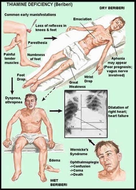 Thiamine Deficiency Beriberi Causes Symptoms Diagnosis Treatment