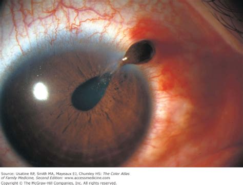 Eye Trauma—Hyphema | Basicmedical Key