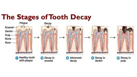 Tooth Decay Causes Symptoms Diagnosis Treatment Lavanya Dental Clinic