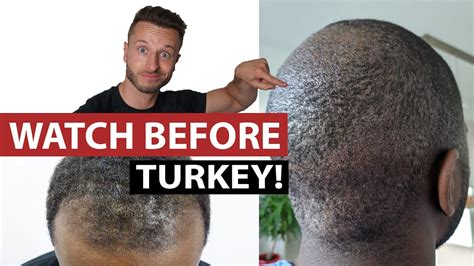 Afro Fue Hair Transplant Turkey 3 Things To Watch Out For Youtube