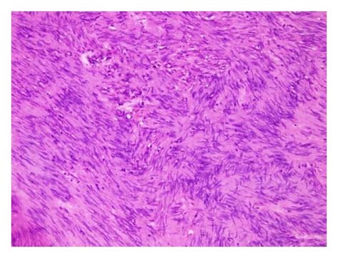 A Interlacing Fascicles Of Spindle Cells H E B High