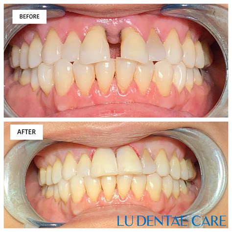 Dentist Before Afters Teeth Whiteningalhambra Dentist 91803