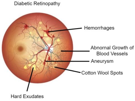 Applied Sciences Free Full Text A Survey On Diabetic Retinopathy Lesion Detection And