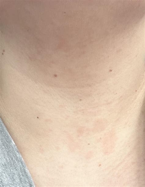 Rash On Neck Rdermatologyquestions