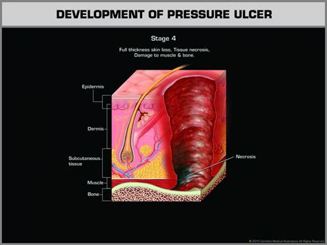 Evidence Illustrations New Jersey Accident Attorney