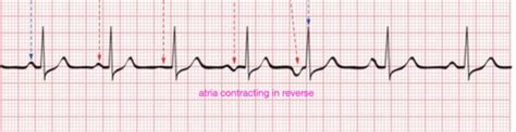 EKG Exam 1 Basics Flashcards Quizlet