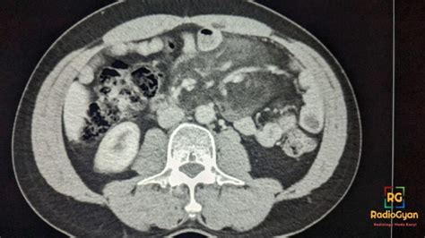 Misty Mesentery Sclerosing Mesenteritis Radiology Case Radiogyan