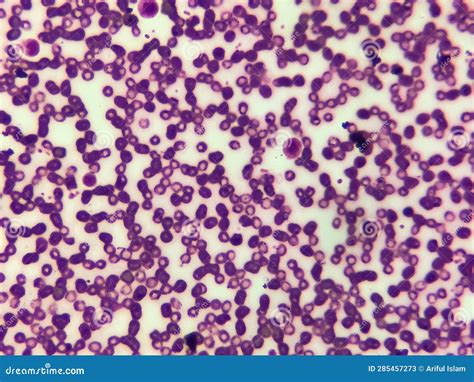 Iron Deficiency Hypochromic Microcytic Anemia Red Blood Cells Stock