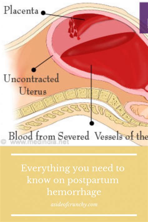 Everything You Need To Know On Postpartum Hemorrhage Postpartum