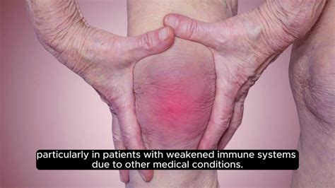 How Does Arthritis Affect The Bones Video Dailymotion