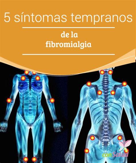 Aprender Sobre Imagem Fibromialgia Sintomas Fotos Br Thptnganamst