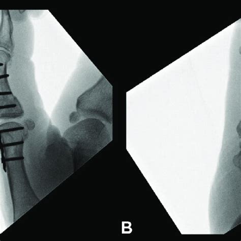 Intraoperative Fluoroscopy A Posteroanterior And B Lateral Views Download Scientific Diagram