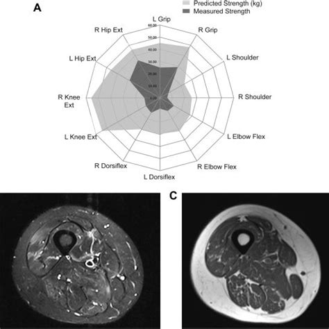 Strength Testing And Muscle Mri Findings Quantitative Muscle Strength Download Scientific