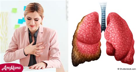 Los S Ntomas M S Comunes De Un Tumor Mesotelioma Pleural